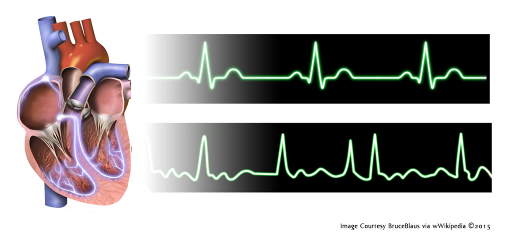 Atrial Fibrillation Image of Heart and EKGs--Top is Normal Rhythm and Bottom is A-Fib Rhythm